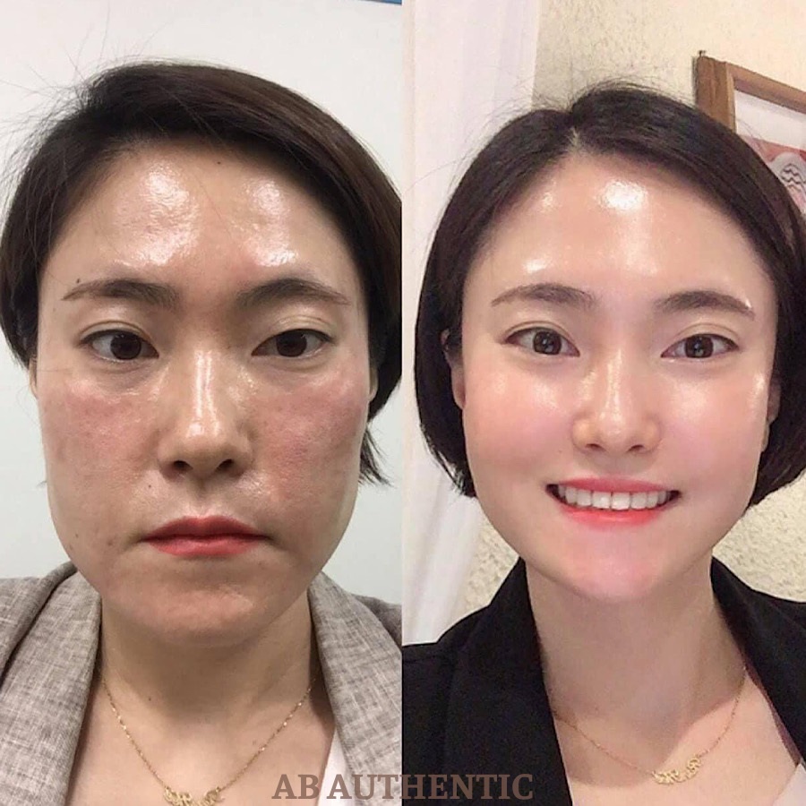 Sample Peel tái tạo da chuyên sâu CNP Rx Skin Rejuvenating Intensive Peel - AB Authentic