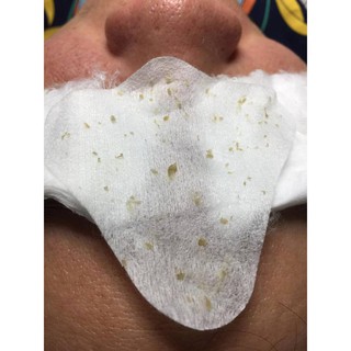 Ủ mụn Youngerc