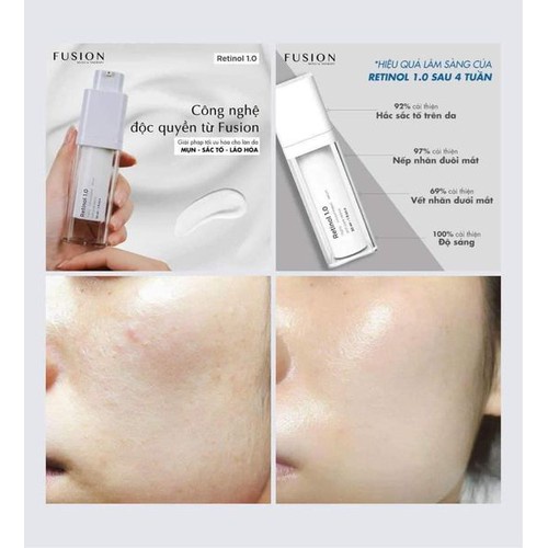 Tinh chất chống lão hóa sáng da ngừa mụn Fusion Retinol 1.0 30ml
