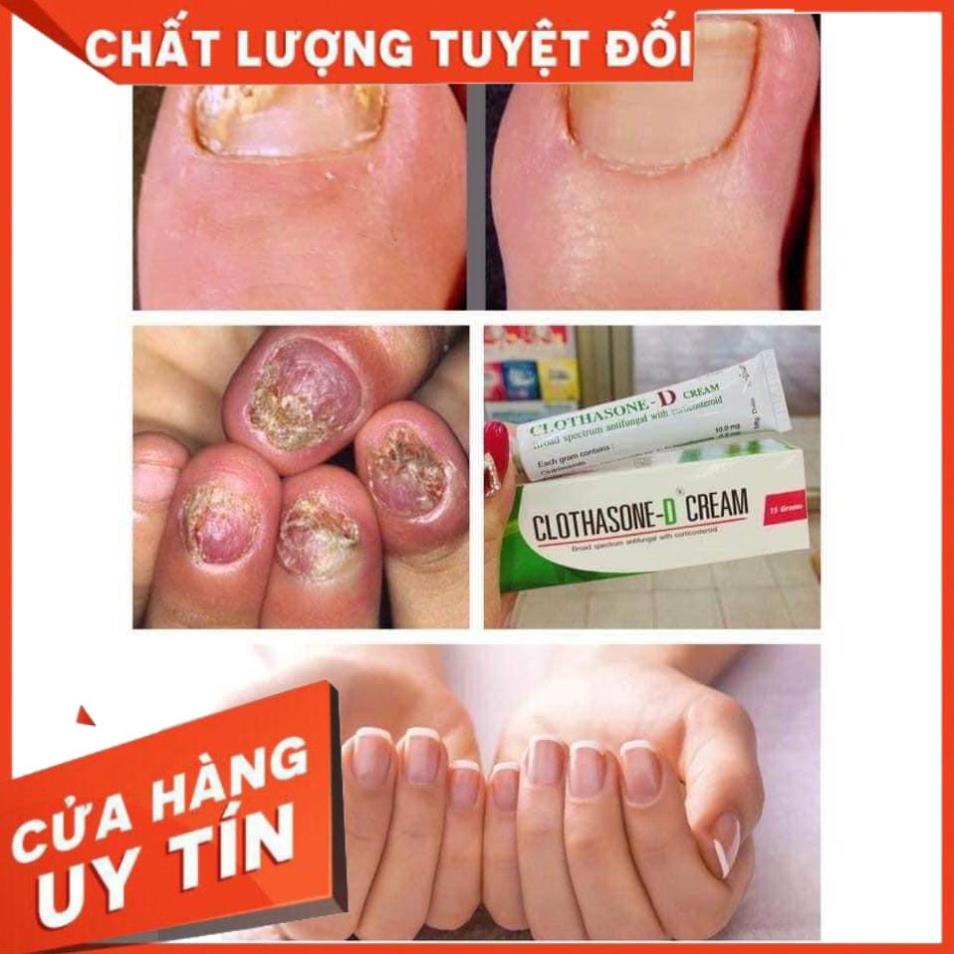 Kem bôi nấm móng tay chân CLOTHASONE -D CREAM Thái Lan 15gr