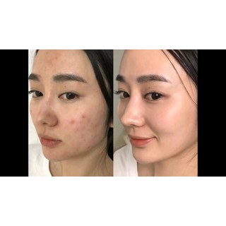 Toner đẩy mụn AHA-BHA-PHA 30DAYS TONER