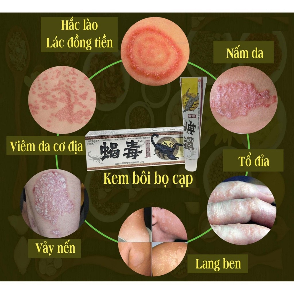 Kem bọ cạp bôi nấm ngứa, hắc lào, á sừng, nấm da đầu, vảy nến