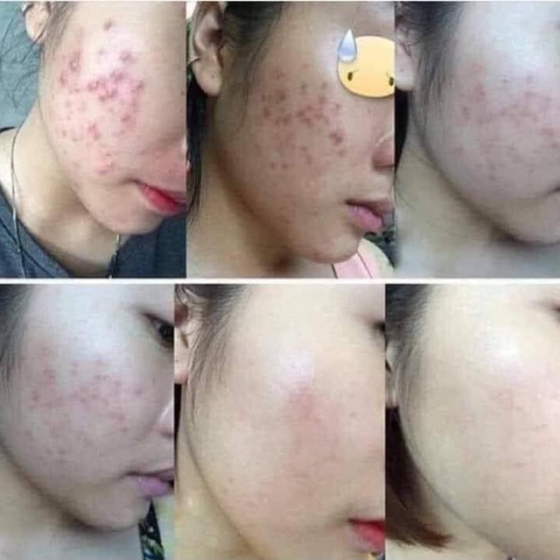 Ngừa mụn Lê Xuân🍀thảo dược đông y lê xuân🍀loại bỏ mụn trứng cá, mụn ẩn, mụn viêm,… | BigBuy360 - bigbuy360.vn