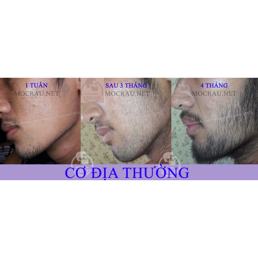 #FREESHIP - Minoxidil 5% Kirkland chính hãng - Dung Dịch Mọc Râu Tóc - Trị Hói - Dưỡng rậm Chân Mày | BigBuy360 - bigbuy360.vn