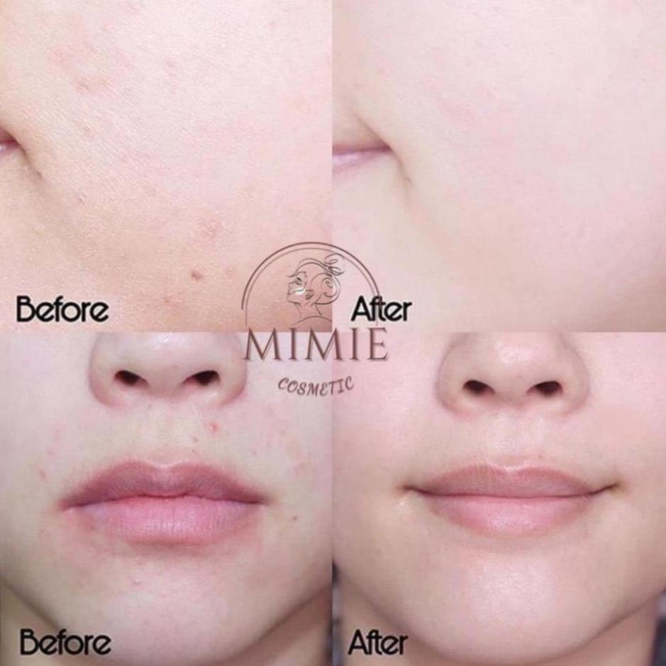 Retacnyl Tretinoin Cream Kem Hỗ Trợ Giảm Mụn, Chống Lão Hóa, Trẻ Hóa Da 0,025%, 0,05% - Galdema Chính Hãng Pháp