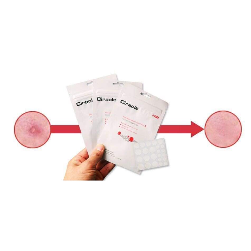 MIẾNG DÁN MỤN CIRACLE RED SPOT ACNE PIMPLE PATCH CHÍNH HÃNG - 5621