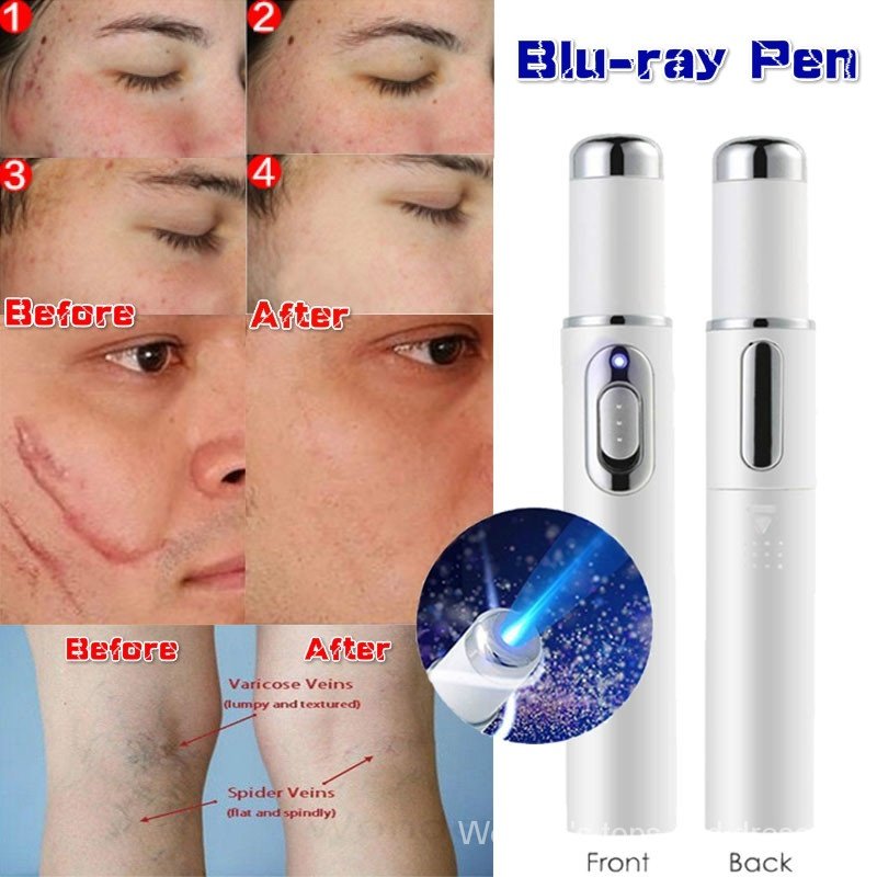 (Hàng Mới Về) Bút Laser Trị Mụn Trứng Cá / Mạng Nhện 4joi Tiện Dụng