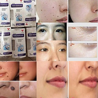 [ giá sỉ tại kho] Gel tẩy nốt ruồi lồi, mụn thịt, mụn cơm và sẹo lồi, thịt thừa Cynep hàng Nga chính hãng