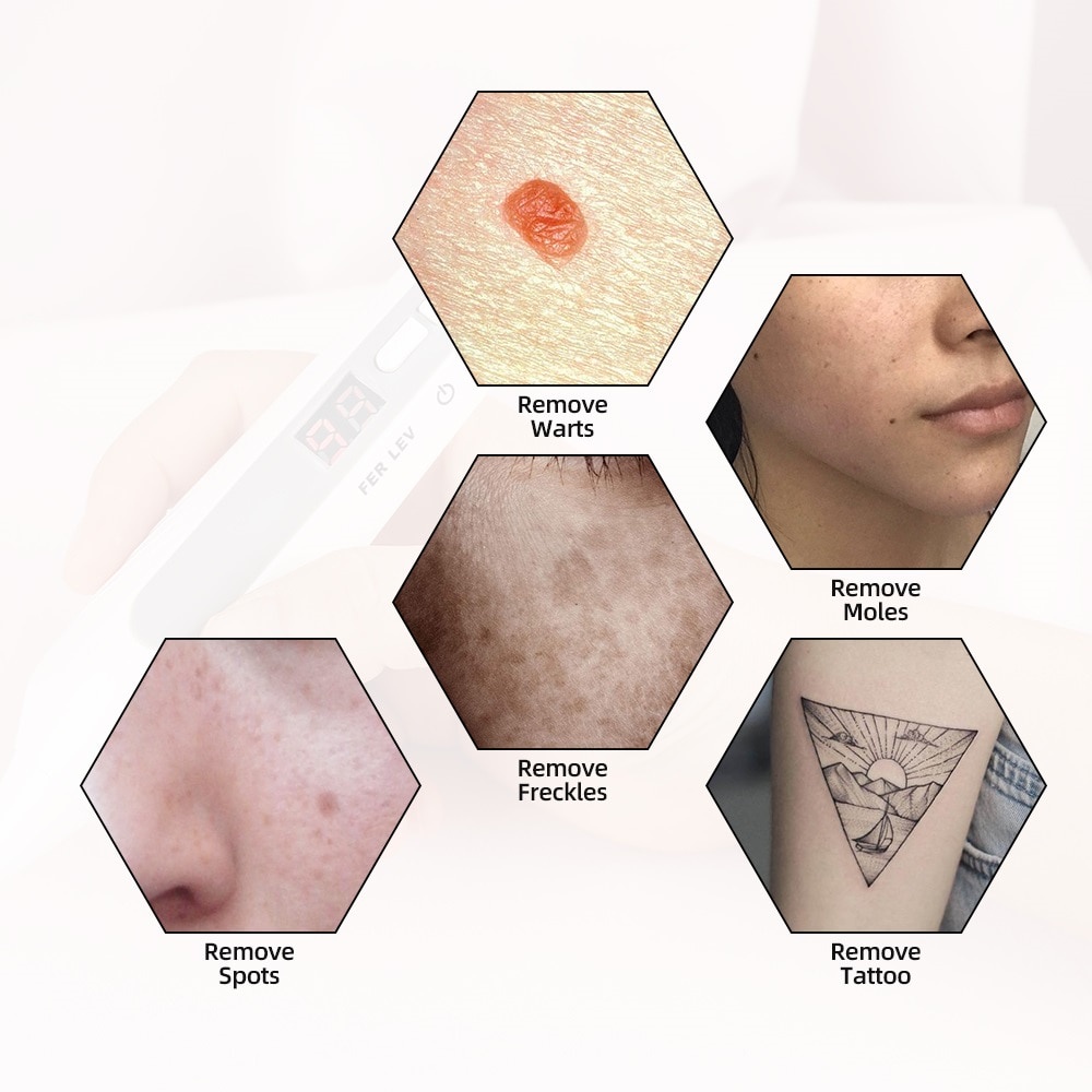 Foreverlily Mãi mãi  Bút Laser 9 Cấp Độ Có Thể Sạc Lại Dùng Hỗ trợ giảm tàn nhang Đốm Đen Và Tàn Nhang