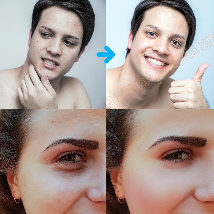 Kem ngừa mụn giảm mụn CANOVA Acnell 50mL hỗ trợ giảm viêm, giảm tiết bã nhờn làm dịu, tái tạo da | BigBuy360 - bigbuy360.vn