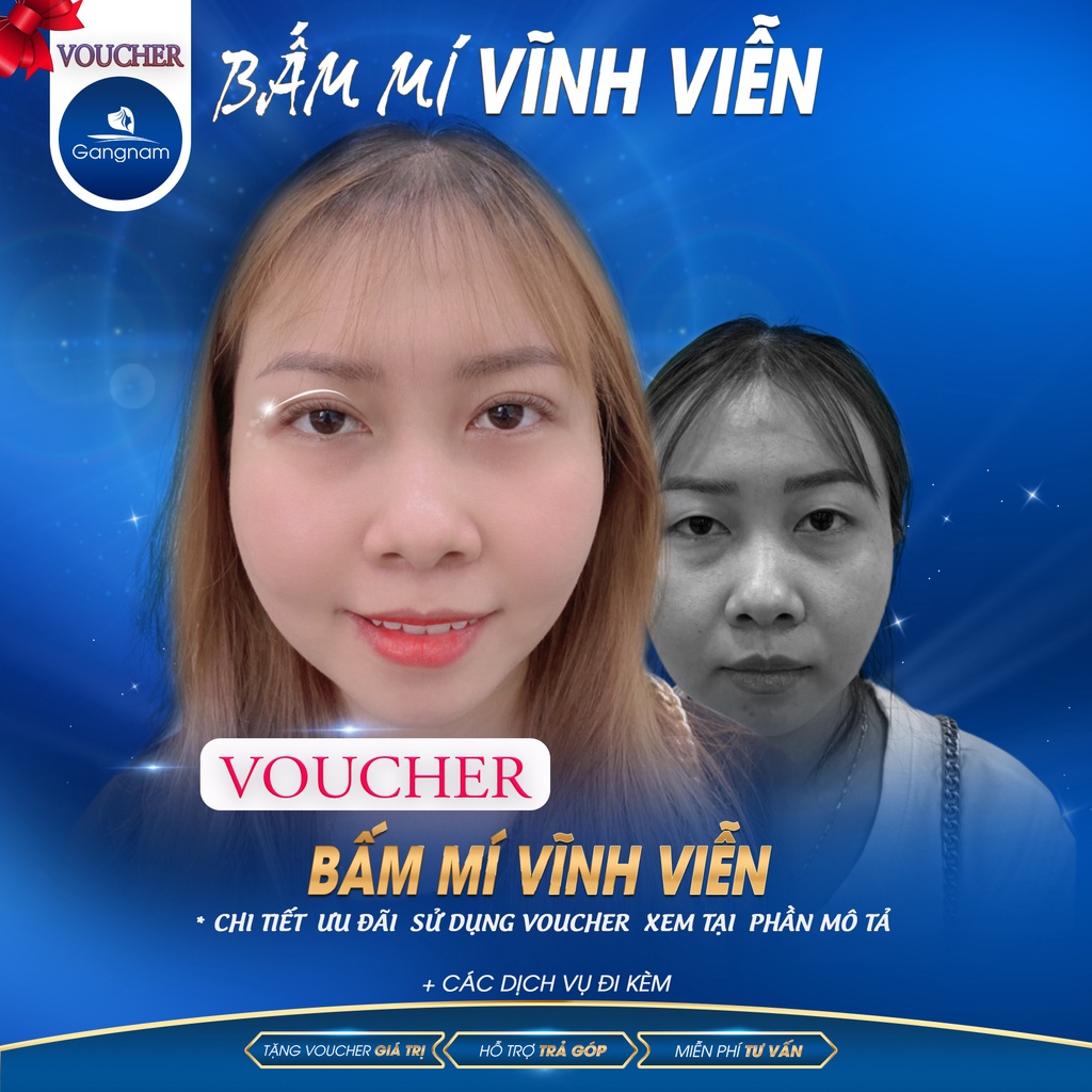 Nhấn Mí Vĩnh Viễn | Thẩm Mỹ Viện Gangnam
