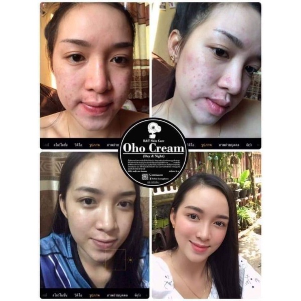 KEM OHO cream ☺ giảm mụn, thâm, sẹo 15g.