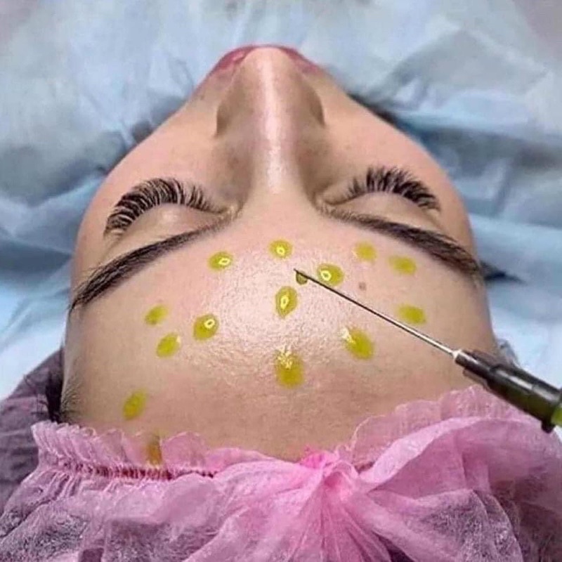 Tinh Chất Peel Da Căng Bóng Giảm Mụn BioRePeelCl3 Italy