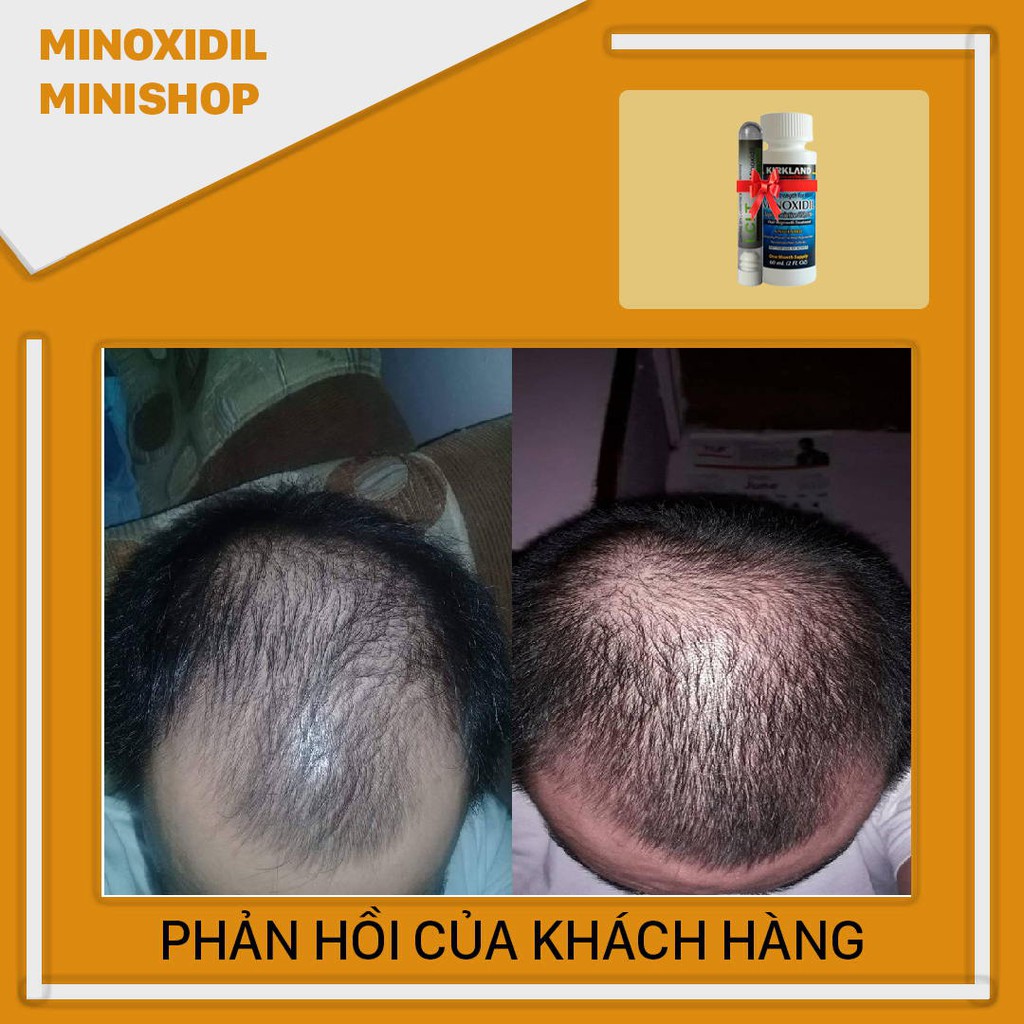 Minoxidil 5% lỏng combo bột LCLT giúp mọc râu nhanh