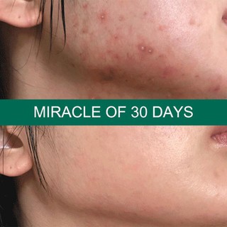 SET Trị Mụn Some By Mi AHA- BHA-PHA 30 Days Miracle(KTS)