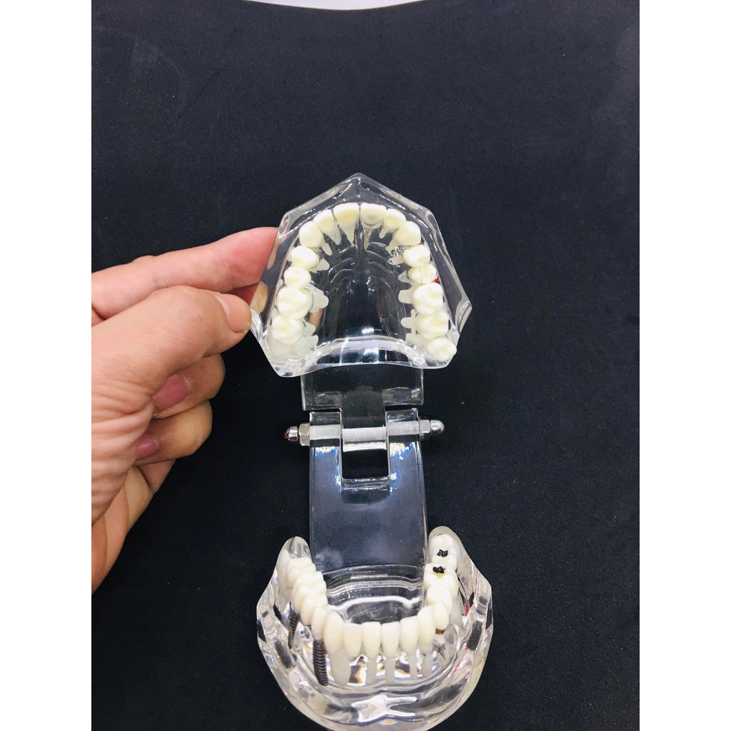 Mẫu hàm tư vấn nha khoa,mô hình tư vấn sâu răng,cắm implant,sún răng