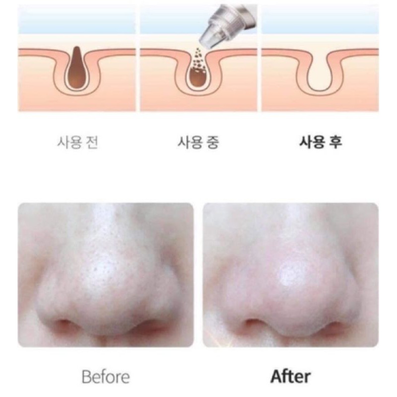 Máy hút mụn Hàn Quốc Beauty Suction