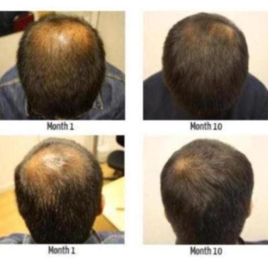 Thuốc ngăn rụng, kích mọc tóc siêu mạnh Higher Strength Kaminomoto Nhật Bản 200ml | BigBuy360 - bigbuy360.vn