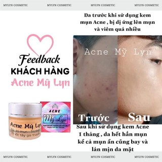Acne Mỹ Lyn (tặng kèm quà rất xinh)