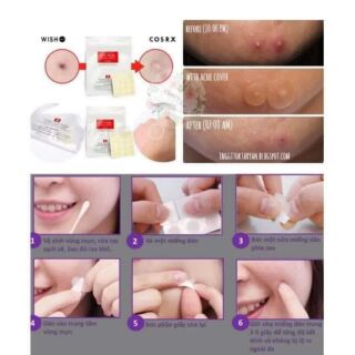 Miếng dán trị mụn Acne