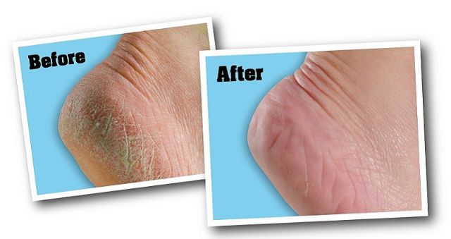 Kem trị nứt gót chân Heel Spa Thái Lan (50ml) | BigBuy360 - bigbuy360.vn