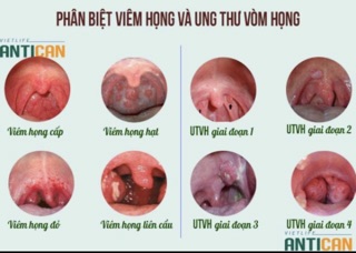 Ho , viêm họng , amidan Cụ Làng Nghè