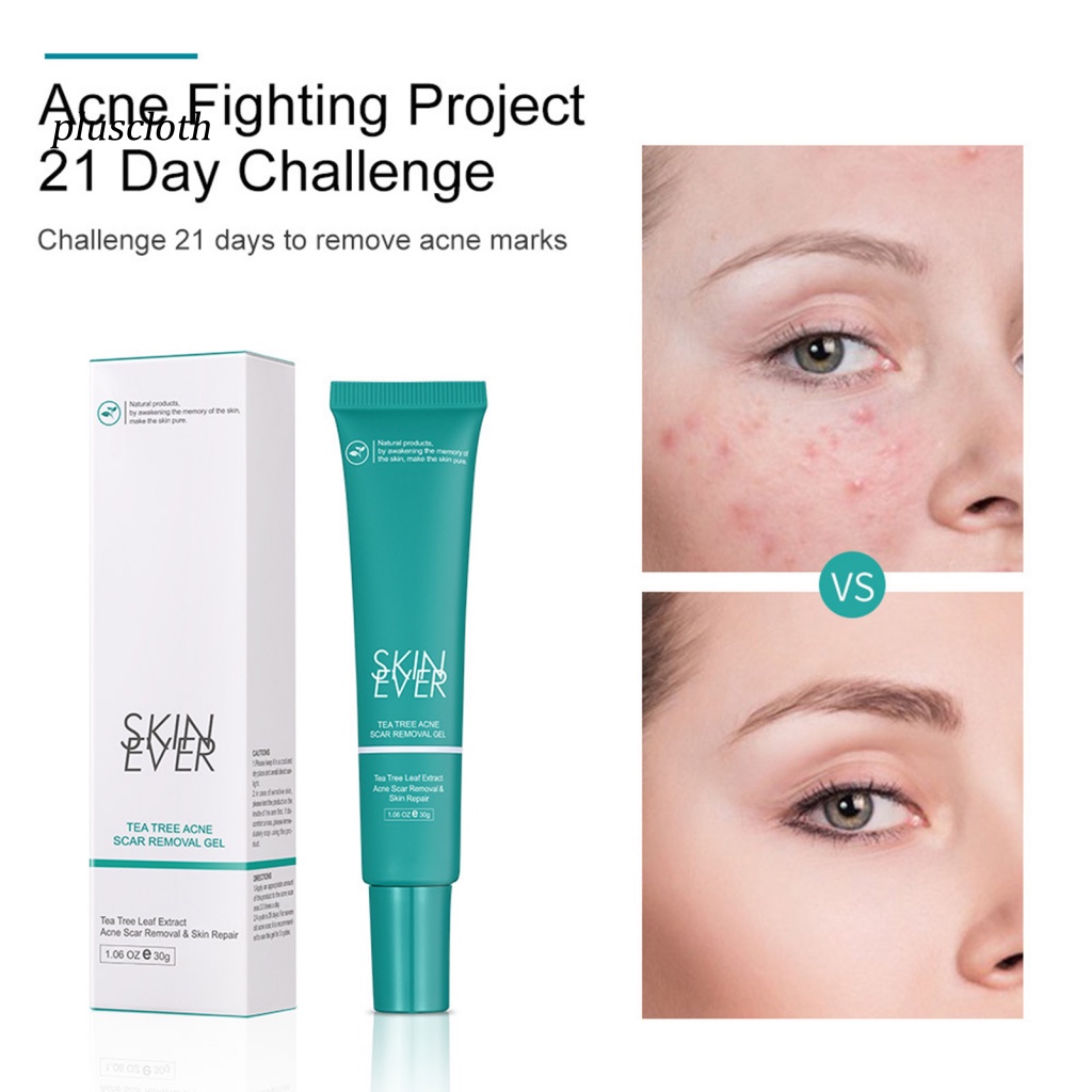 Tuýp Kem Hỗ trợ giảm mụn Trứng Cá Chăm Sóc Da Mặt 30g