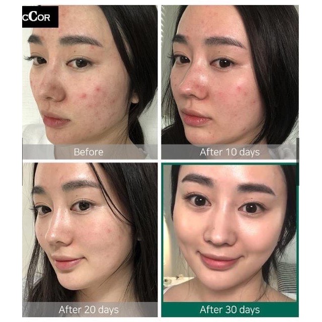 Nước Hoa Hồng AHA BHA PHA 150ml dành cho da mụn - Bini.store.official