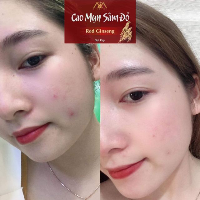 Cao Mụn sâm Đỏ 36 Vị Giảm Mụn Và Dưỡng Da