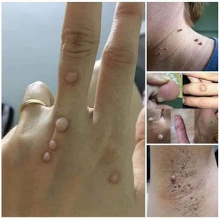 Gel xóa ruồi , mụn cóc , mụn thịt