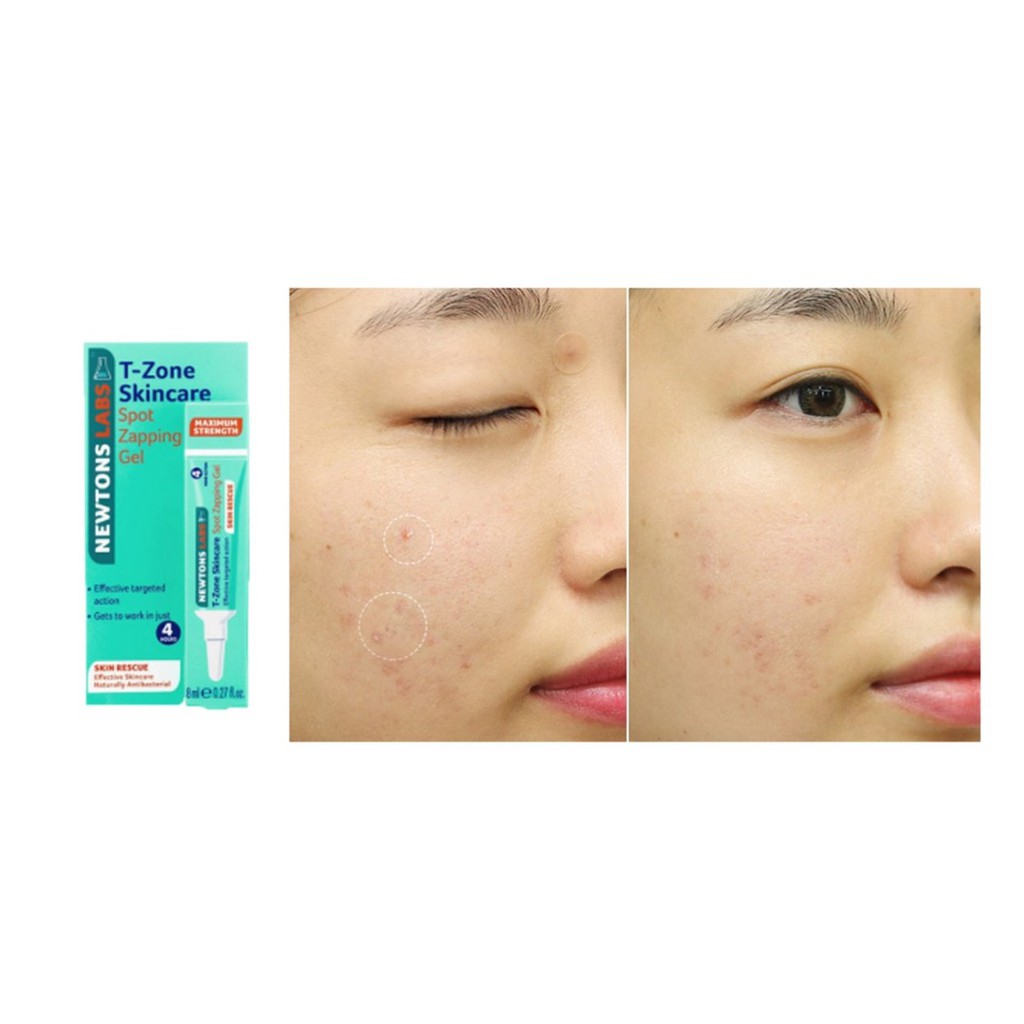 Gel Giảm Mụn Cấp Tốc, Ngăn Ngừa Mụn T-Zone Spot Zapping Gel 8ml