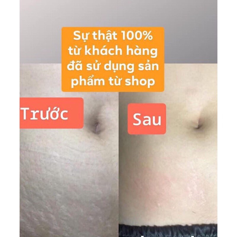 Kem rạn thần thánh Stretcheal ( có bill đầy đủ từ nhà sản xuất)