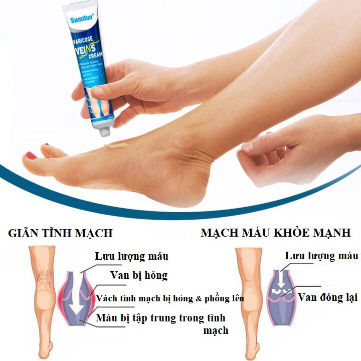 Kem bôi giãn tĩnh mạch - Đọc kỹ HDSD