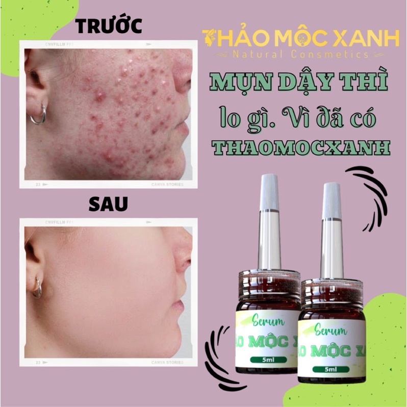 [GIÁ SỈ] COMBO 5 LỌ SERUM THẢO MỘC XANH CHÍNH HÃNG | WebRaoVat - webraovat.net.vn