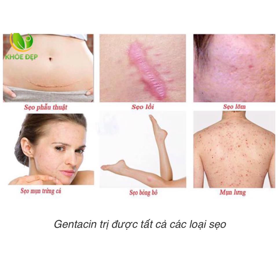 Kem cải thiện SẸO Gentacin Nhật Bản tuýp 10g Hỗ Trợ Cải Thiện Sẹo Lồi Sẹo Lõm Sẹo Cứng Đầu