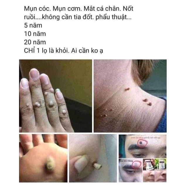 Gel tẩy nốt ruồi, mụn cóc, mụn thịt, tàn nhang, sẹo lồi Develinil - Hàng Nga