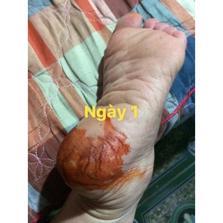 Bôi Nứt Gót Chân kiểu gì cũng hết nứt