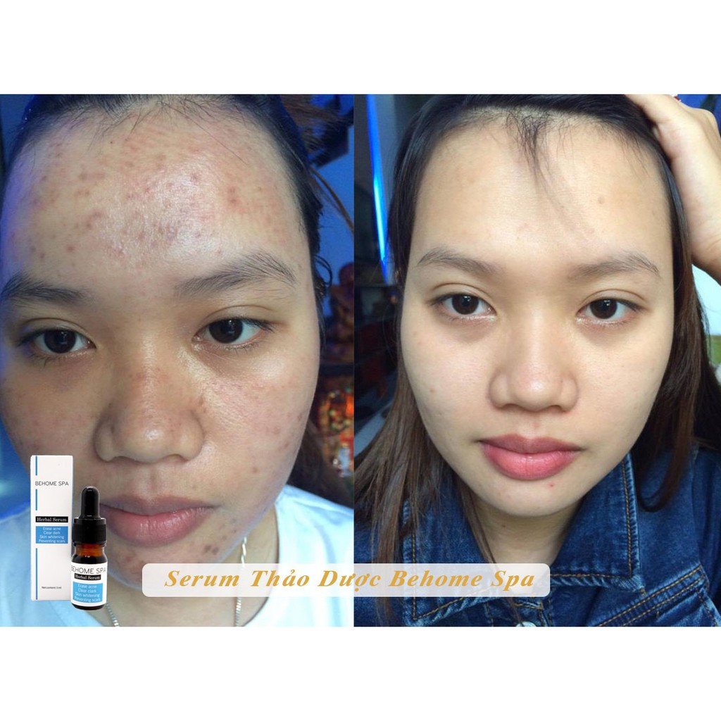 Serum thảo dược Behome Spa giảm mụn thâm, se lỗ chân lông - sản phẩm cho spa chăm sóc da tại nhà