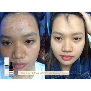 Serum thảo dược Behome Spa giảm mụn thâm, se lỗ chân lông - sản phẩm cho spa chăm sóc da tại nhà