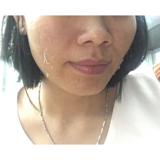 Hcm nano peeling điều trị mụn, thâm