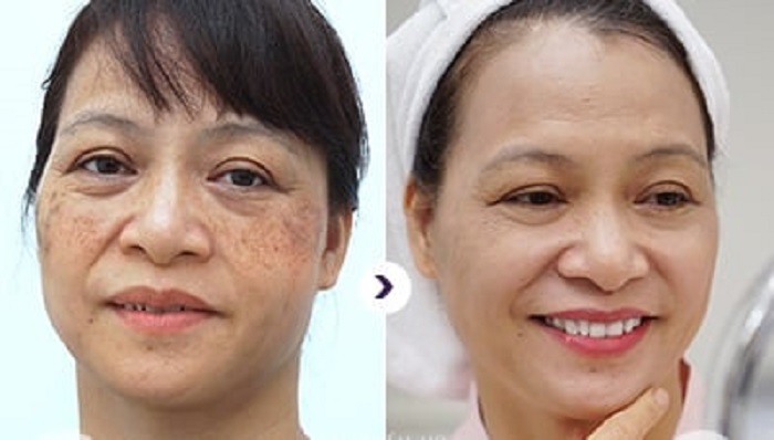Nám Tàn Nhang Nặng Mấy Cũng hết Nhờ em Gel Dr.Skin Này - chính hãng
