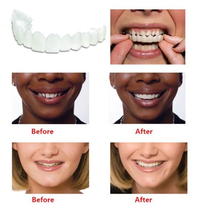 Dụng cụ niềng răng tại nhà snapon smile