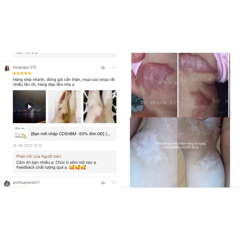 Kem làm mờ sẹo Contractubex Đức, tuýp 30g