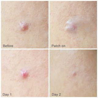 Miếng Dán Mụn Cosrx Acne Pimple Master Patch