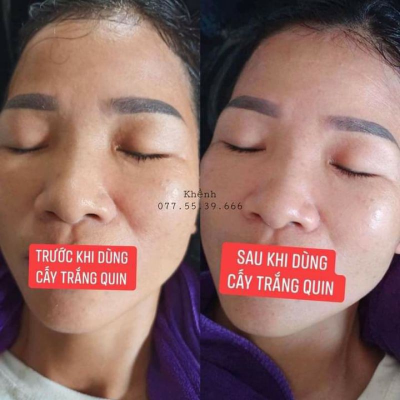 CẤY TRẮNG FACE QUIN TRẮNG HỒNG RẠNG RỠ 100% CHÍNH HÃNG | BigBuy360 - bigbuy360.vn