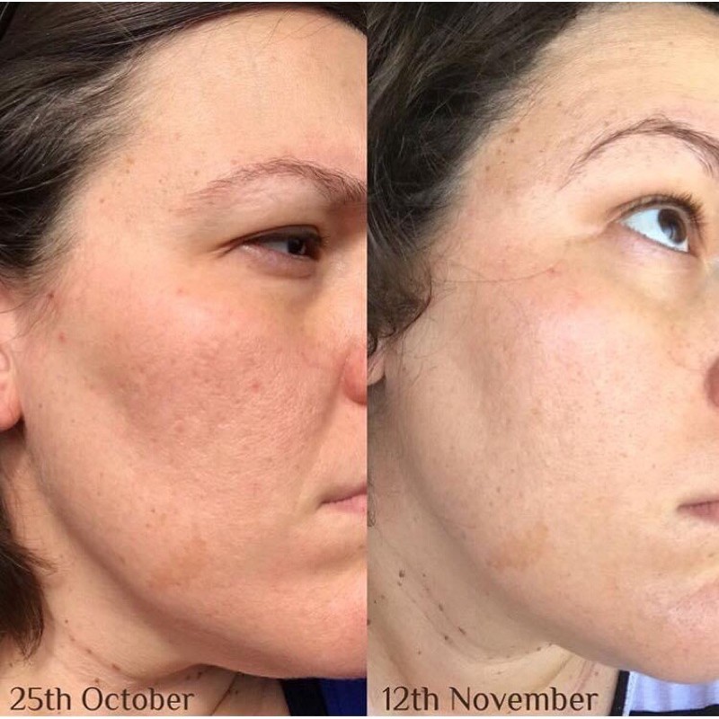 Kem hỗ trợ giảm mụn Azclear Action Lotion 25gr (Azelaic acid) | BigBuy360 - bigbuy360.vn