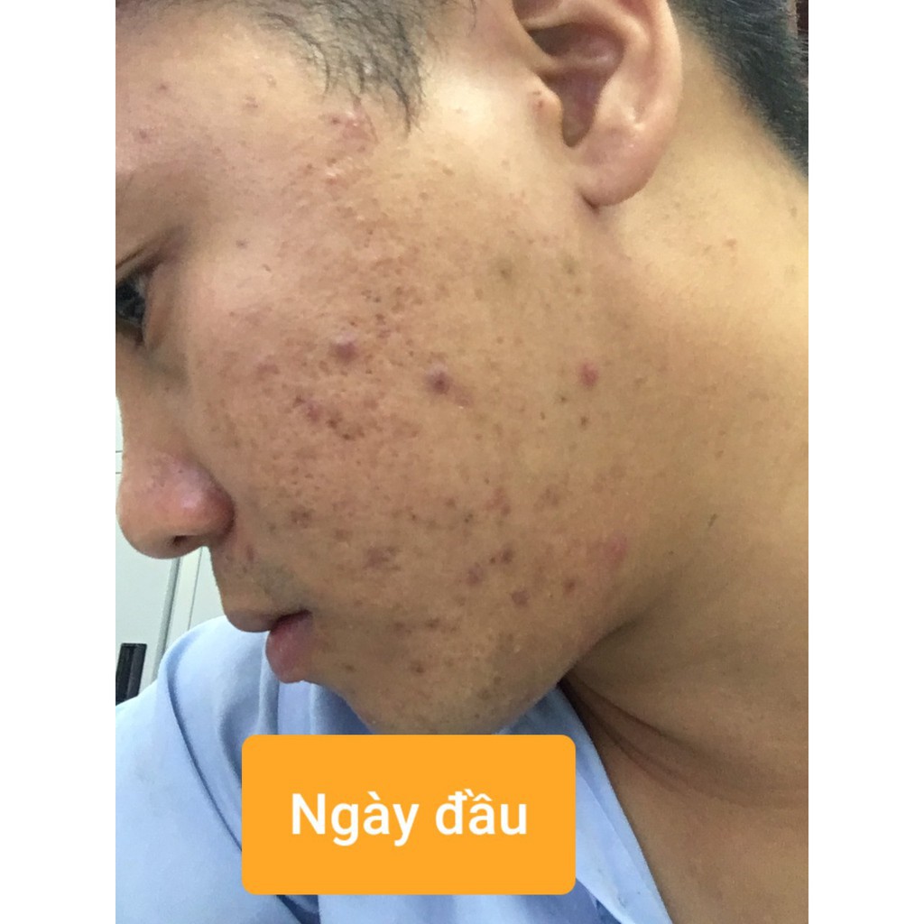 HUYẾT HỒNG SÂM - VUA TRỊ MỤN - ĐÔNG DƯỢC VŨ ĐỨC - 10ML | BigBuy360 - bigbuy360.vn