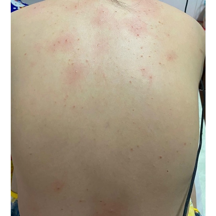 Xịt mụn toàn thân Thái Lan Vitara SE BODY ACNE SPRAY giảm thâm mụn, sẹo mụn 50ml