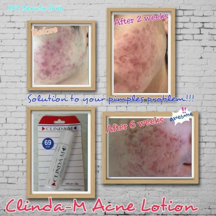 Serum chấm mụn CIinda M 15ml