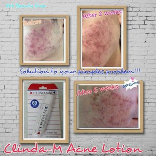 Serum chấm mụn CIinda M 15ml